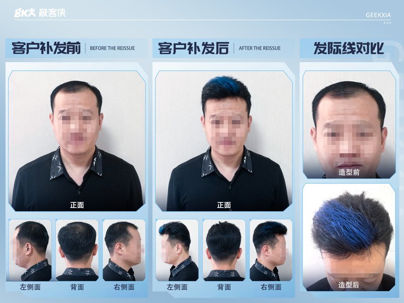 男生发际线高怎么办？