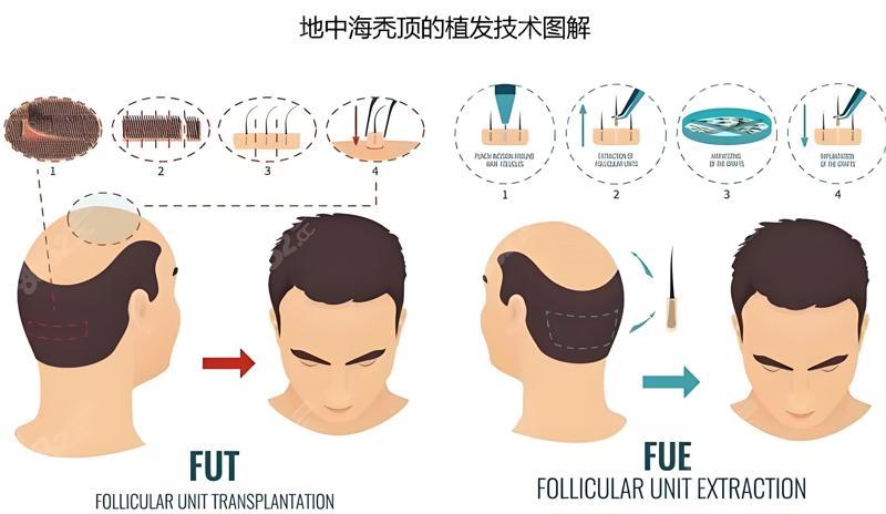 植发技术图解