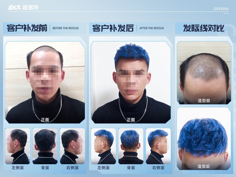 秃顶假发补发效果 秃顶假发补发效果