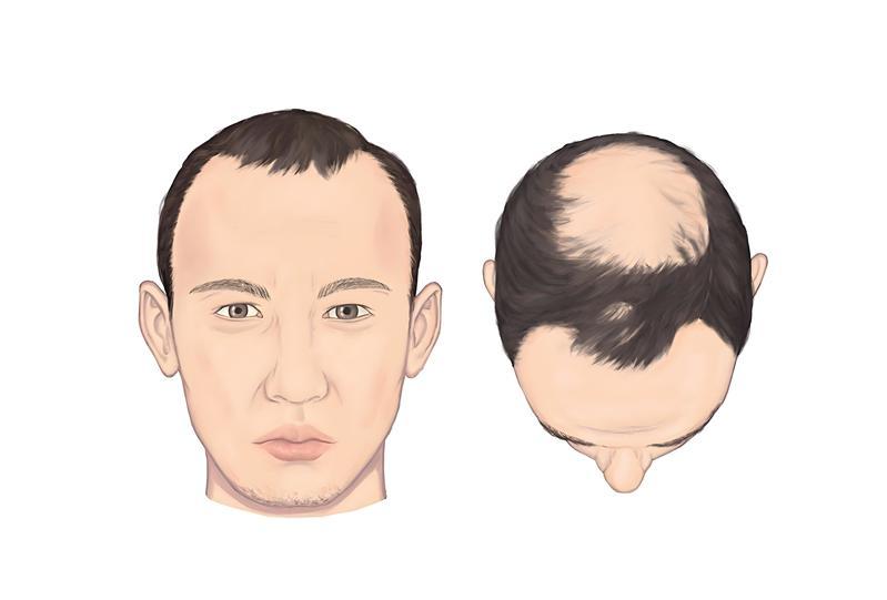 雄性脱发十年，还能回到浓密吗？