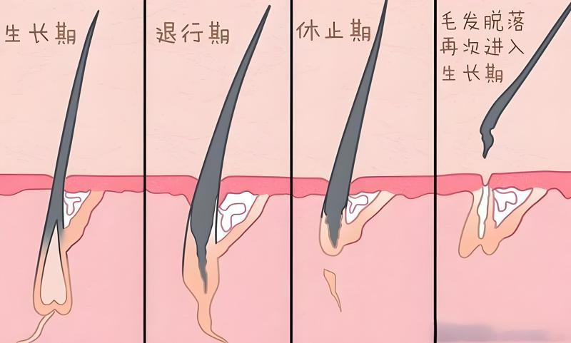 针对严重或慢性不断休息期脱发,恢复时间能延长至6个月之上,乃至2至3年。 针对严重或慢性不断休息期脱发,恢复时间能延长至6个月之上,乃至2至3年。