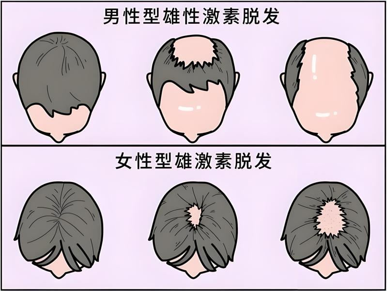雄激素性脱发有救吗？