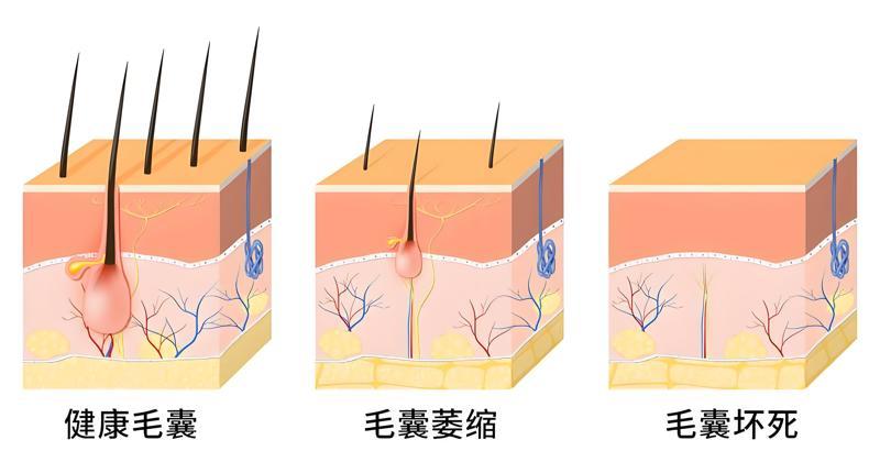 植发后毛囊会掉出来吗? 植发后毛囊会掉出来吗?