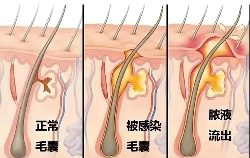 毛囊状态