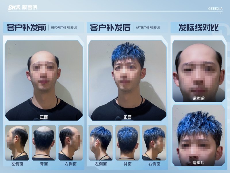 男朋友秃顶补发效果