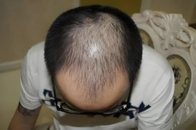 植发费用的范围