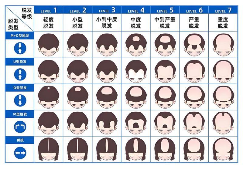 头顶稀疏算几级脱发？