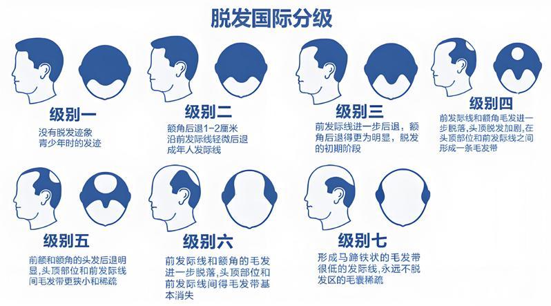 脱发等级图