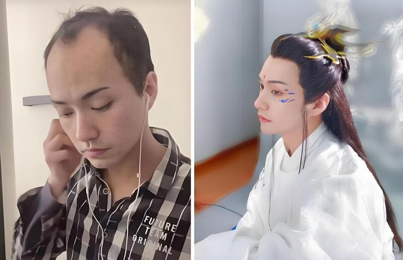 非脱发严重型或有其他替代方式