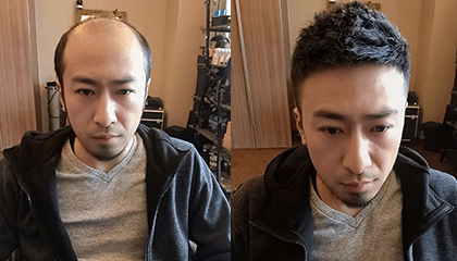 李先生男士补发案例