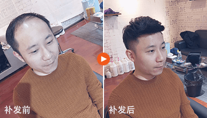 生物头皮——老爸恢复青春的秘密法宝   
