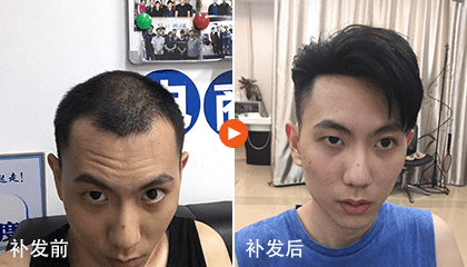 生物头皮让我重新找回自信