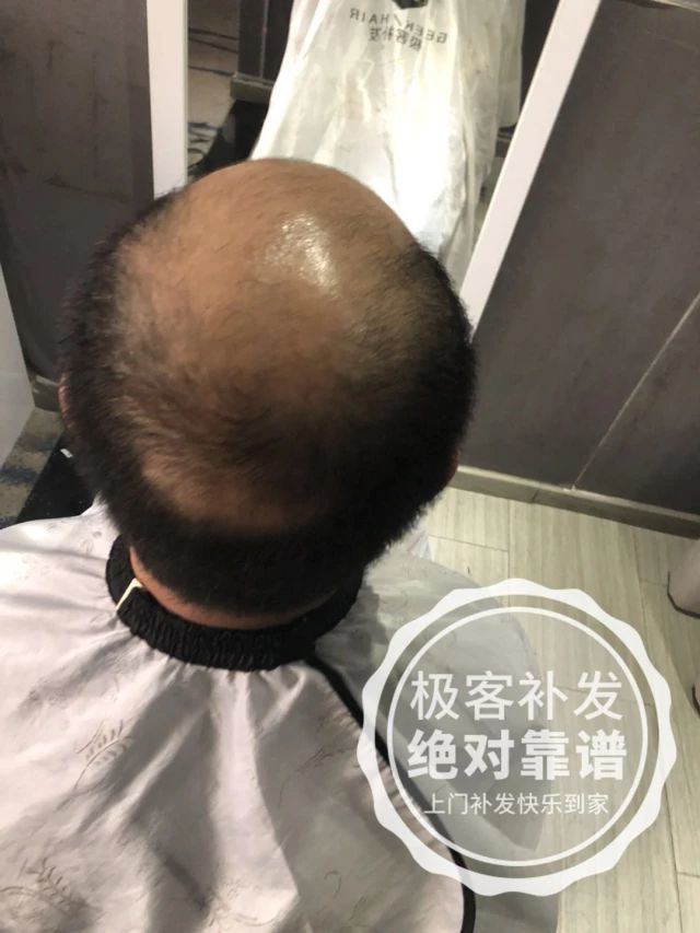 补发前脱发严重秃顶 补发前脱发严重秃顶