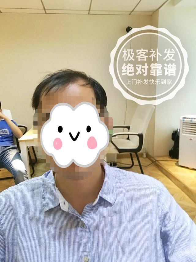 补发前效果，发际线高