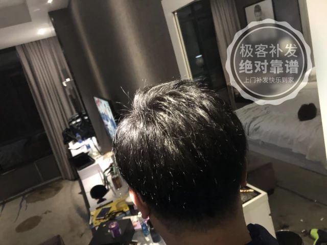 实眼后顶部头发浓密 实眼后顶部头发浓密