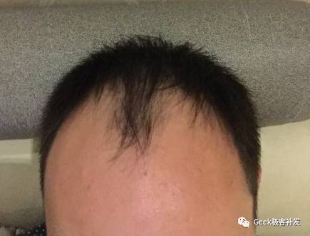 M型脱发 M型脱发